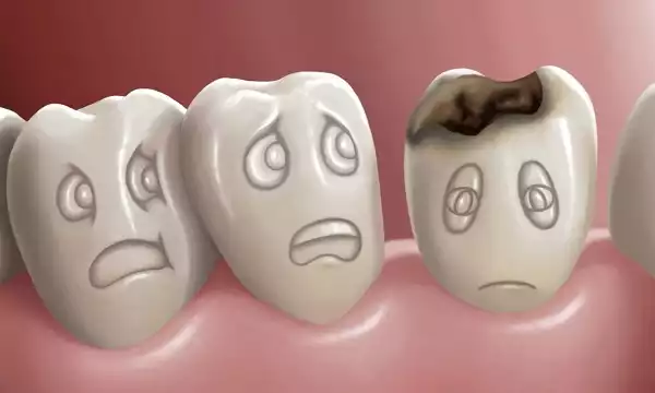Vì sao trẻ bị sâu răng