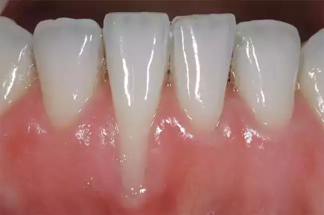 Tụt nướu hay túi nướu gây ảnh hưởng đến răng miệng