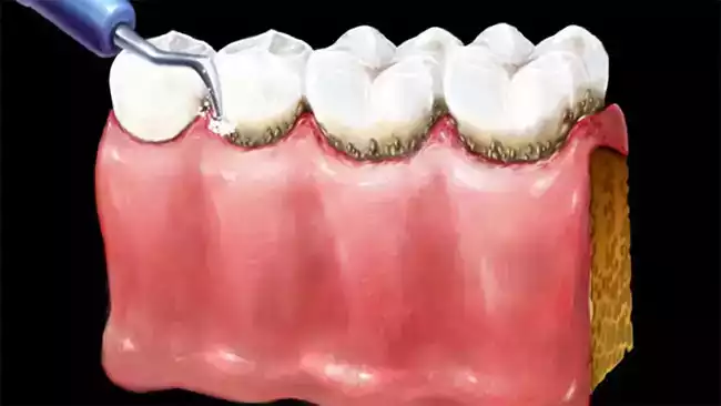 Cao răng rất dễ bám và khó vệ sinh