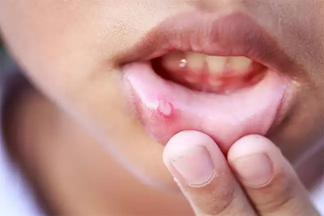 Nhiệt miệng gây nhiều khó chịu thậm chí là dấu hiệu ung thư vòm họng