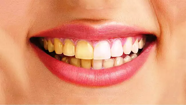 Vàng răng gây mất tự tin cho người dùng