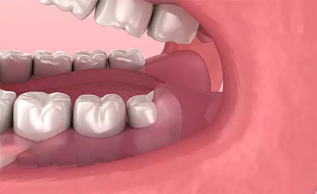 Tình trạng mọc răng khôn diễn ra rất phổ biến