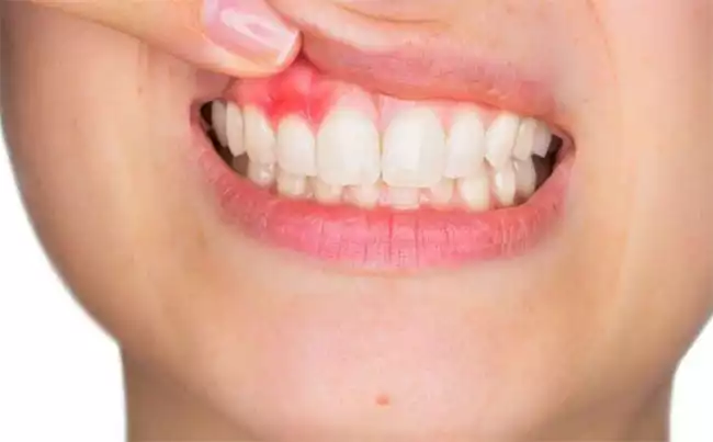 Các bệnh về răng ở trẻ em