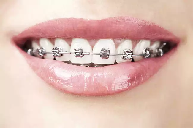 Răng mọc lệch nên xử lý thế nào?
