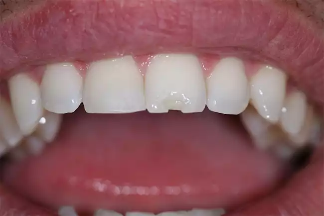 Sứt mẻ răng gây ảnh hưởng đến giao tiếp