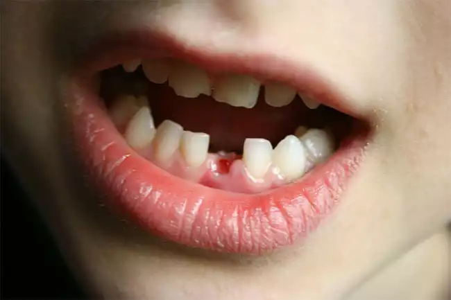 Mất răng là một trong những nguyên nhân gây ảnh hưởng đến sức khỏe