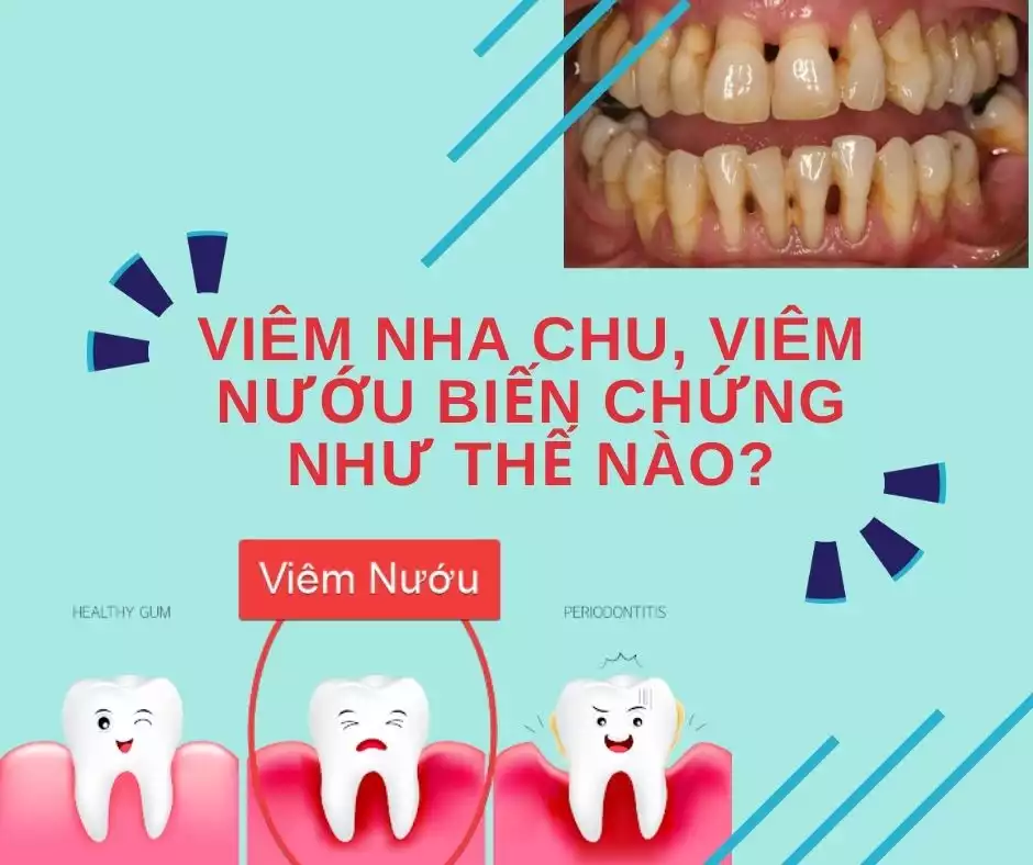 bệnh về răng miệng thường gặp: viêm nha chu, viêm nướu