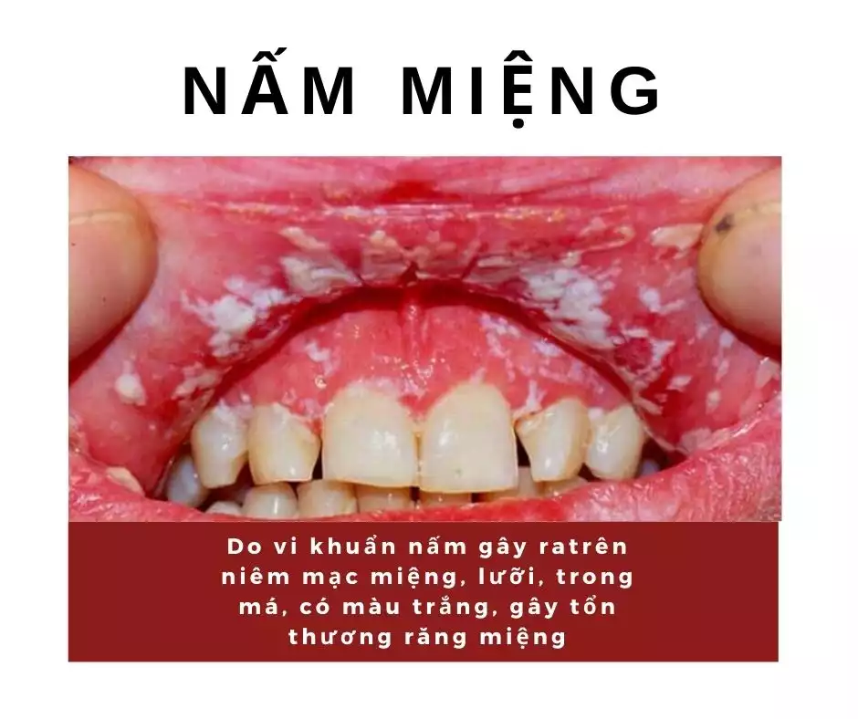 bệnh về răng miệng thường gặp: nấm miệng