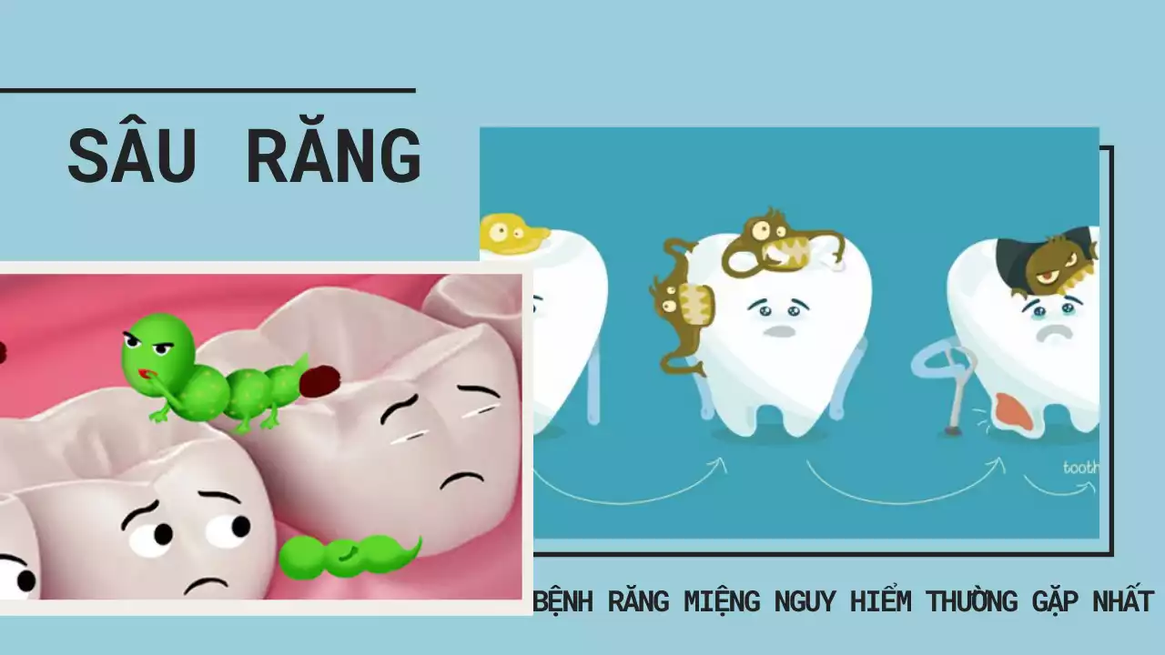 Sâu răng - Bệnh răng miệng nguy hiểm thường gặp nhất