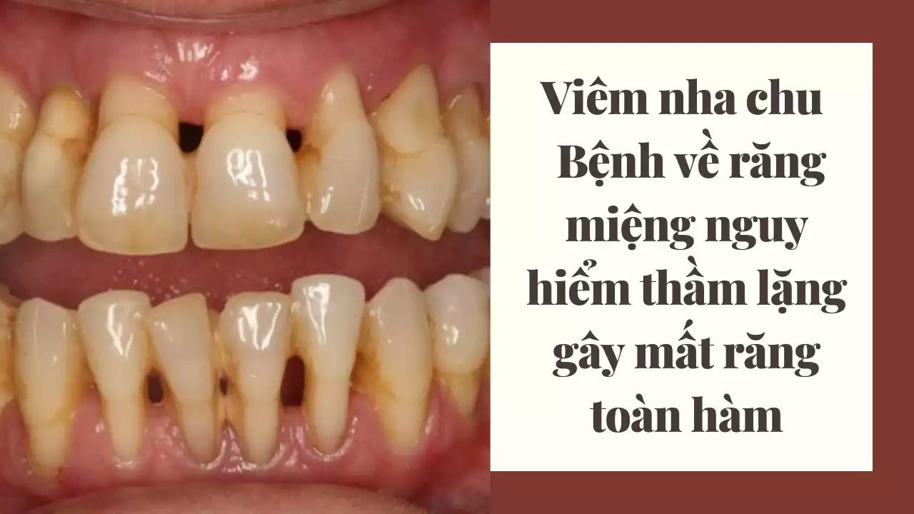 Viêm nha chu - Bệnh về răng miệng nguy hiểm thầm lặng gây mất răng toàn hàm