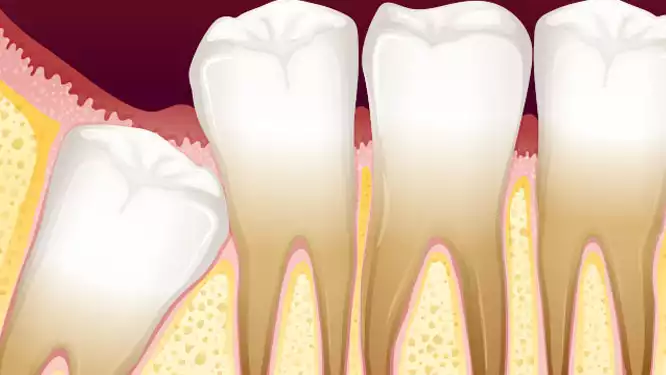 Những biến chứng mà răng khôn gây ra