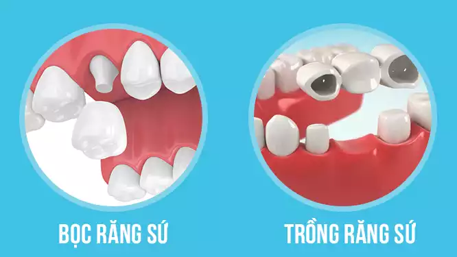 Phân biệt giữa bọc răng sứ và trồng răng sứ